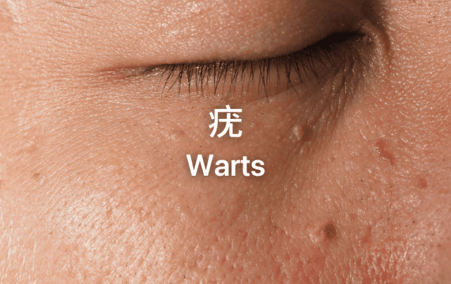 MM website blogarticleEDM cover_Warts